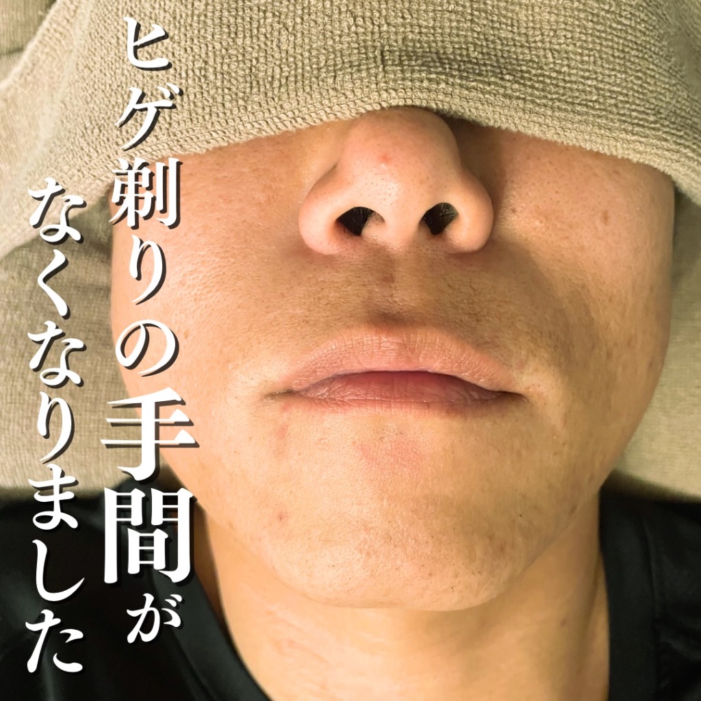 「男性スタッフだから結果が違う」効果重視の脱毛