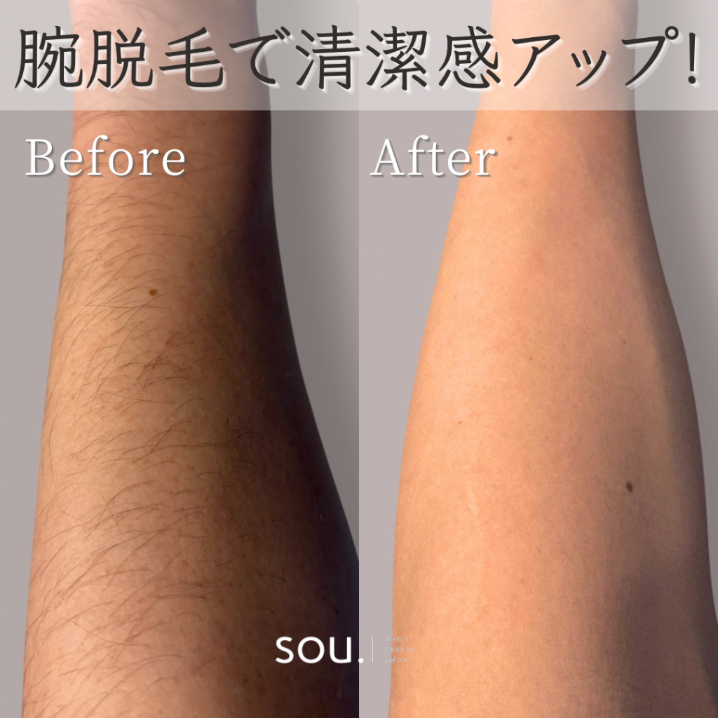 半袖の季節到来！今こそ始める腕脱毛！