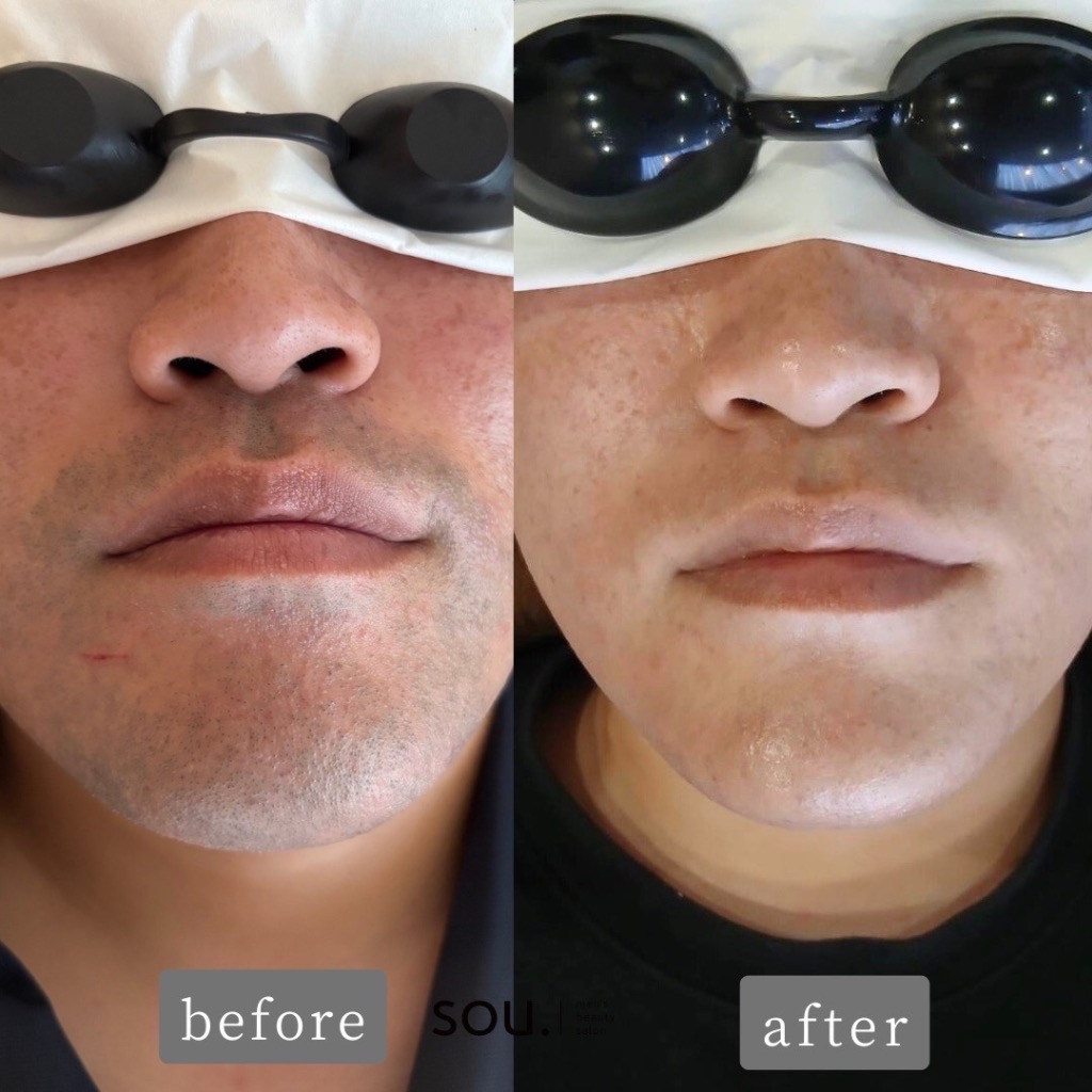 ＼ヒゲ脱毛で顔色も明るく！／