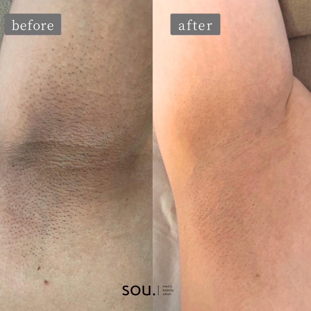 ＼ワキ脱毛で変わったのは、臭い・蒸れ、そして黒ずみ／