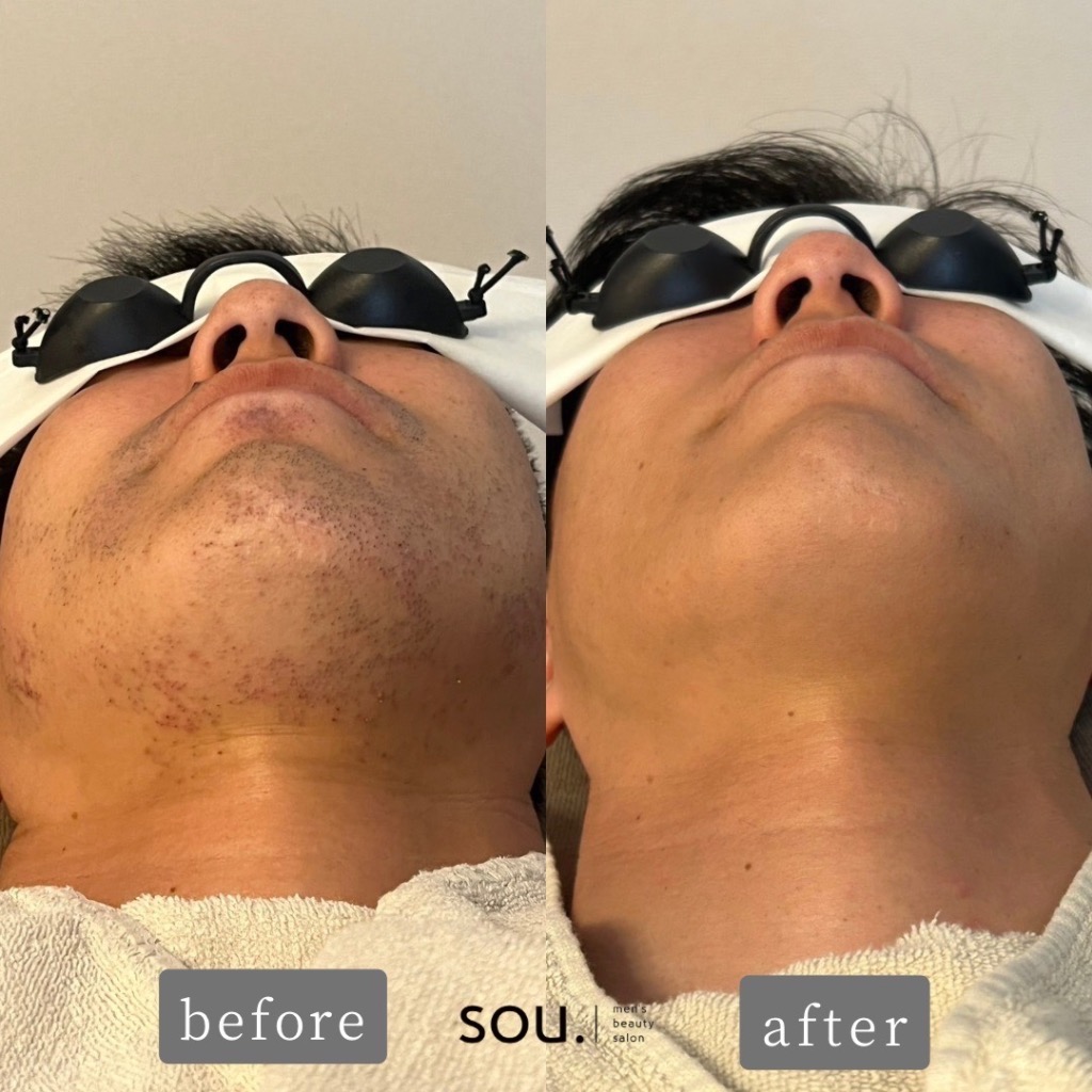 カミソリ負けもゼロに！